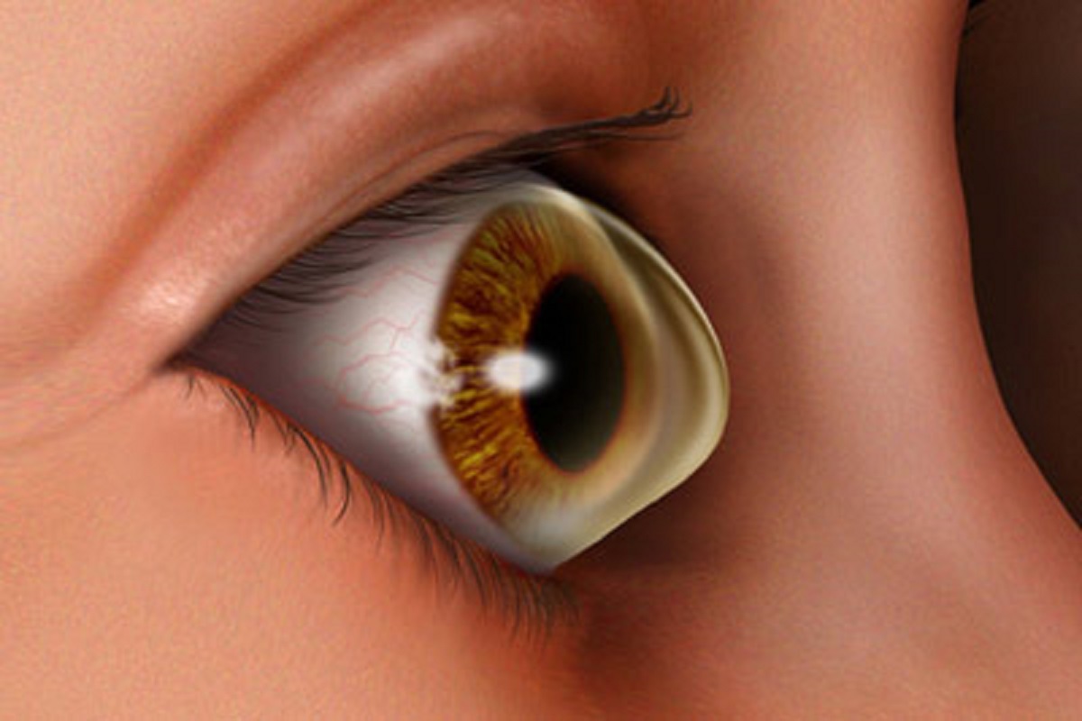 بیماری های چشمی - قوز قرنیه