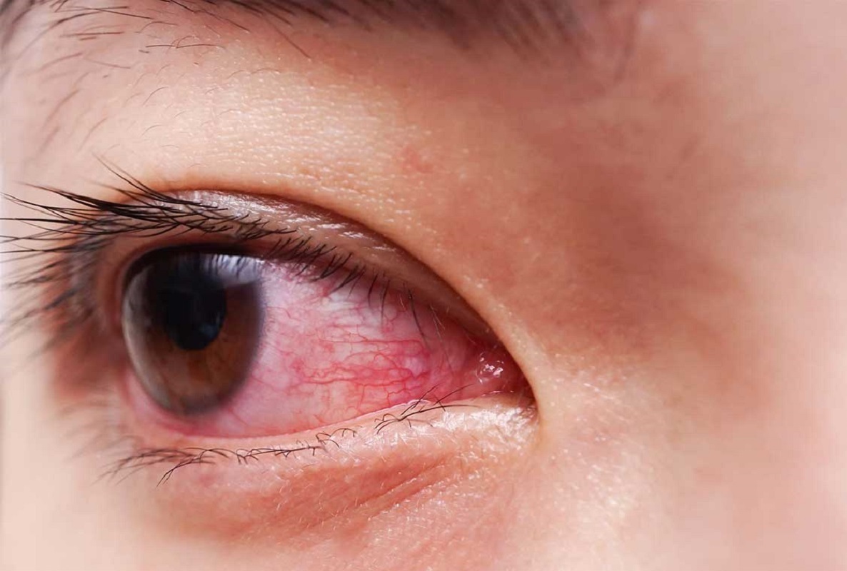 درمان قرمزی چشم - علت قرمز شدن چشم