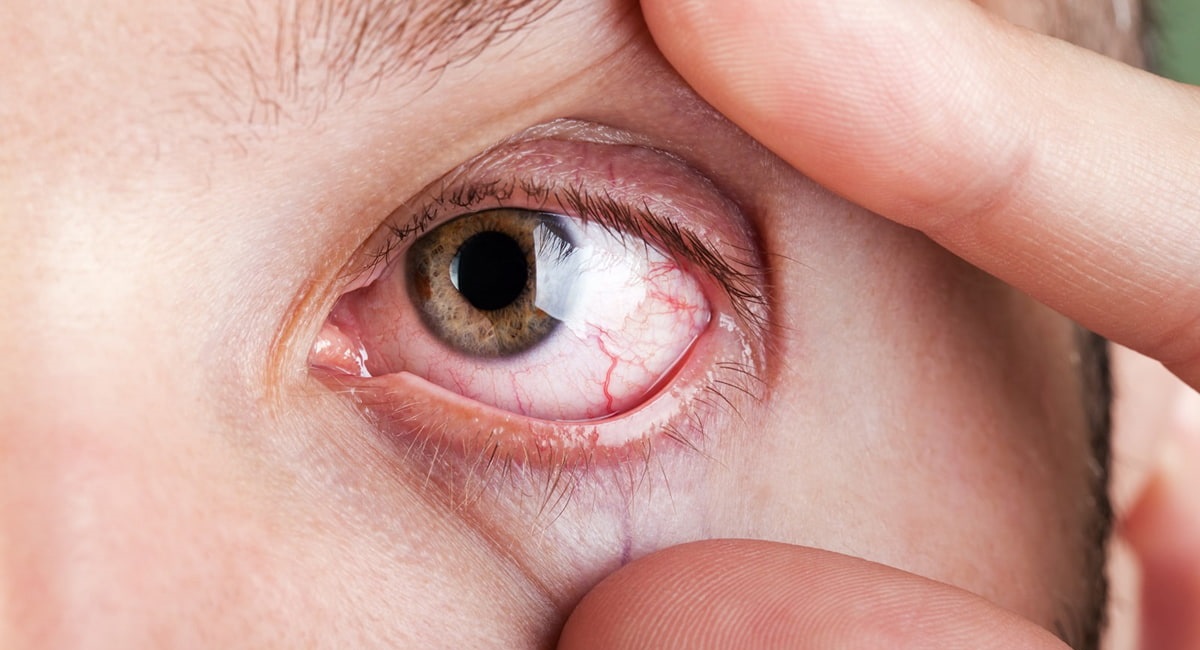 درمان التهاب قرنیه چشم