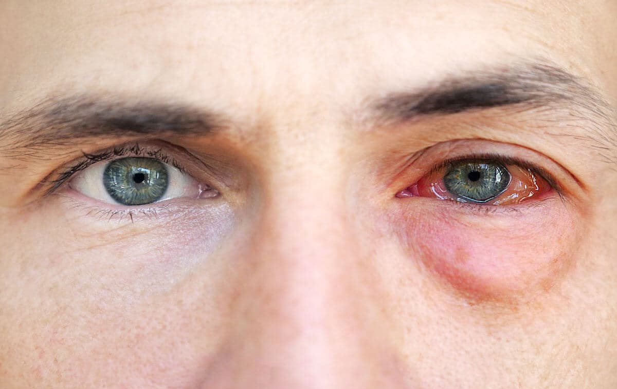 تورم و قرمزی چشم - حساسیت های چشمی