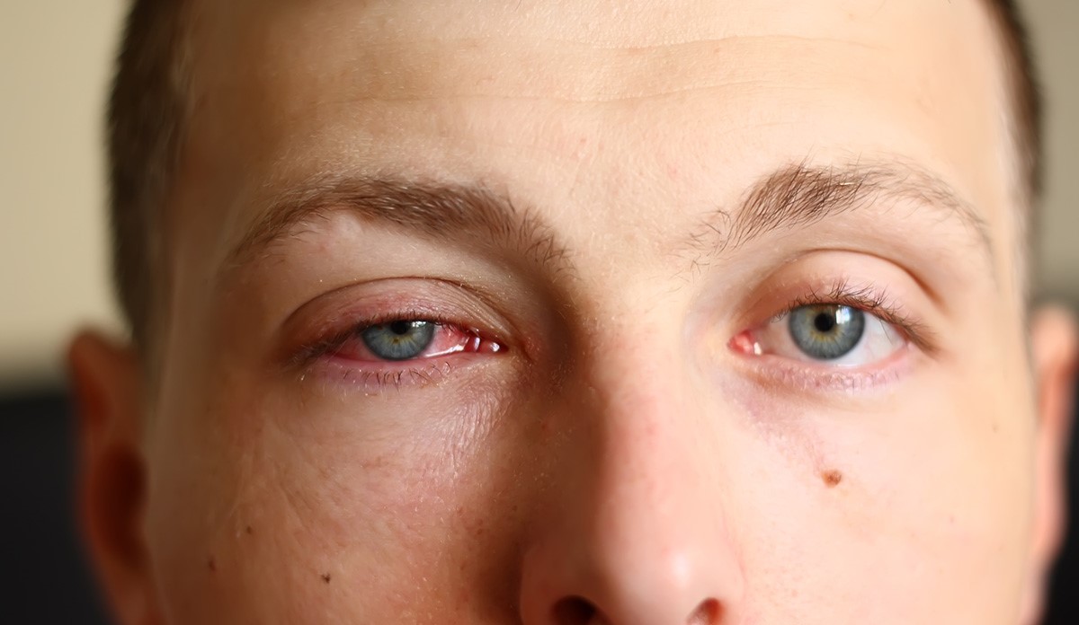 آلرژی چشمی - حساسیت های چشمی