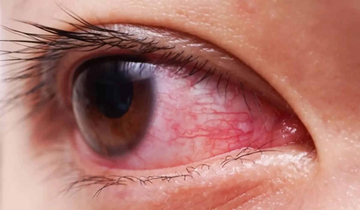 سوزش چشم - تاثیر آلودگی هوا بر چشم ها