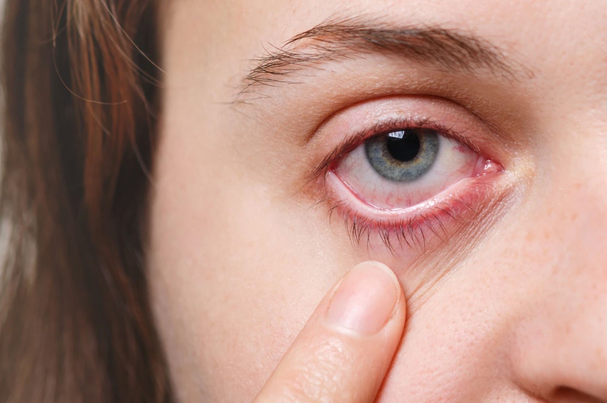 آلرژی چشم - تاثیر آلودگی هوا بر چشم ها