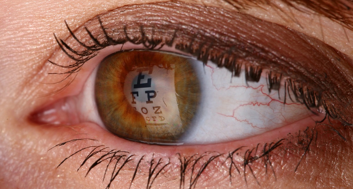 آستیگماتیسم - تست آستیگمات چشم